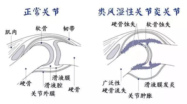 类风湿单关节炎