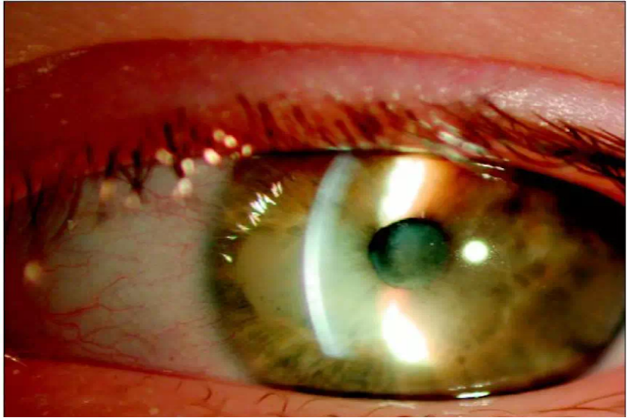 幼年特发性关节炎的眼部症状