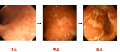 不同严重程度溃疡性结肠炎的肠镜表现