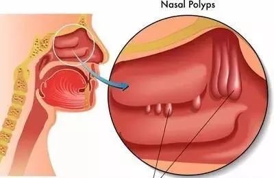 慢性鼻窦炎伴鼻息肉