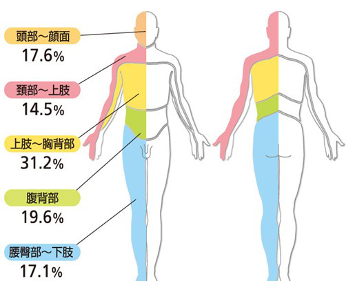 不同部位带状疱疹患病概率