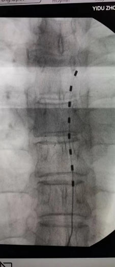 脊髓神经电刺激术将电极置于脊髓硬膜外腔