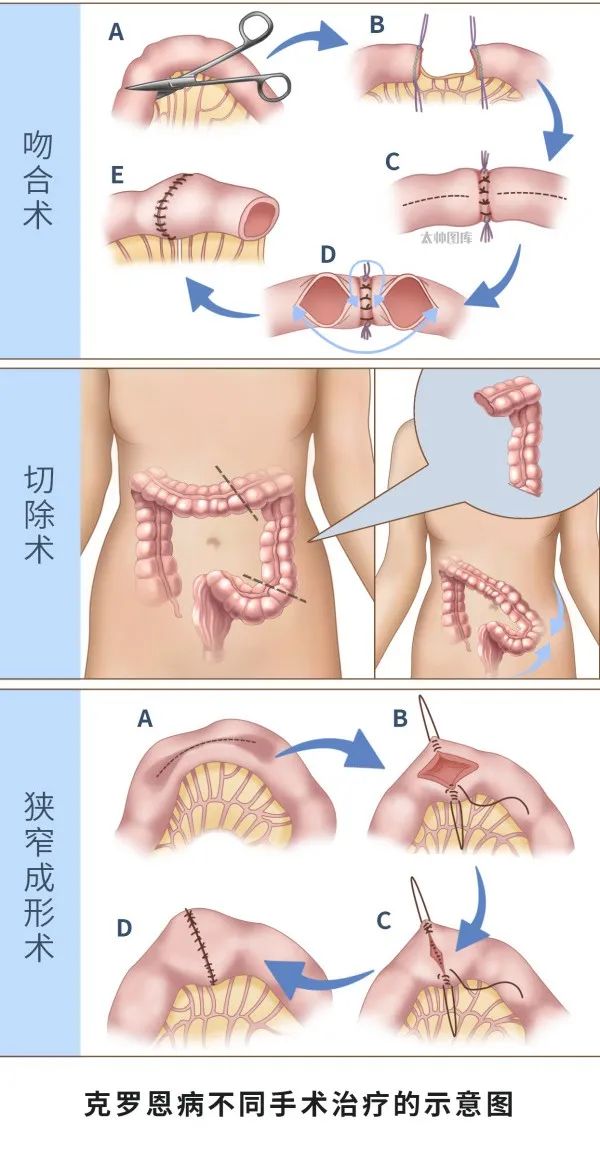 克罗恩病手术治疗