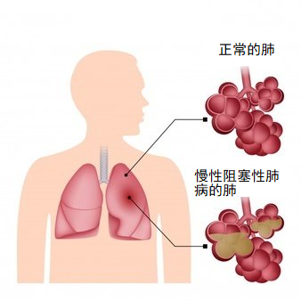 慢性阻塞性肺病