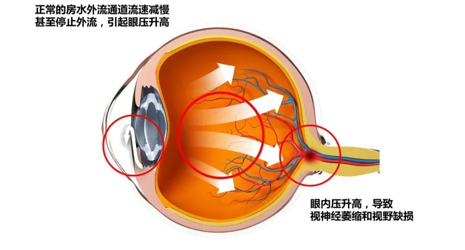 开角型青光眼和闭角型青光眼区别有哪些,开角型青光眼有哪些症状、高发人群有哪些、高发人群有哪些