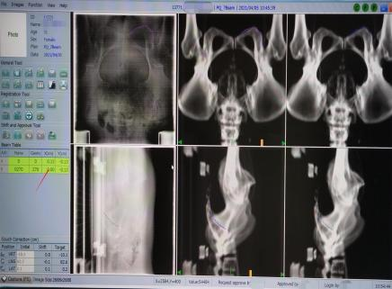 放疗IVS图像引导系统