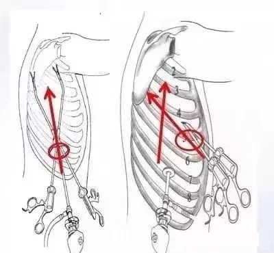 胸腔镜操作示意图