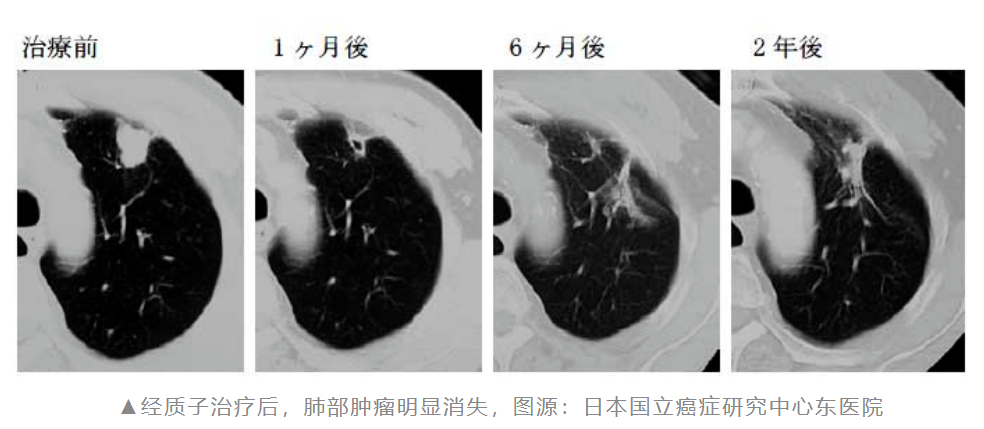 质子治疗肺癌的效果