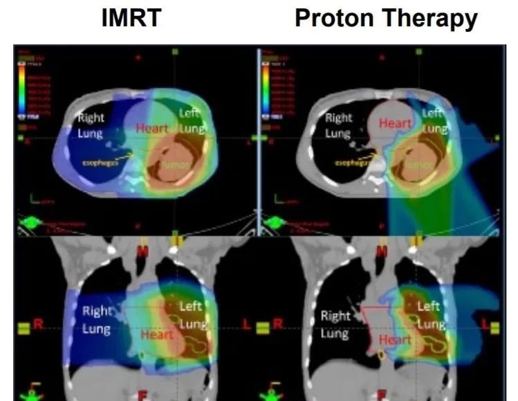 肺癌质子治疗和传统放疗对比