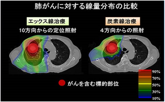 肺癌重离子治疗和传统放疗对比