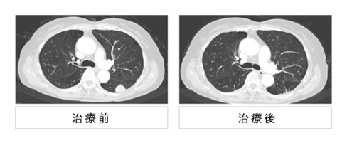 肺癌重离子治疗的效果