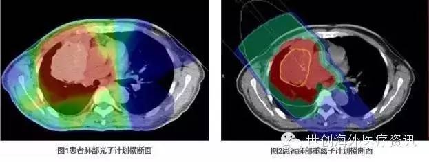 肺癌光子放疗和重离子放疗横断面对比