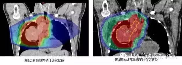 肺癌光子放疗和重离子计划冠状位对比