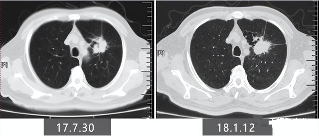 肺癌靶向治疗后病灶变大
