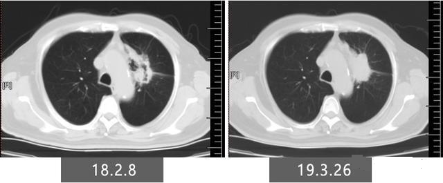 肺癌靶向治疗病灶进一步变大