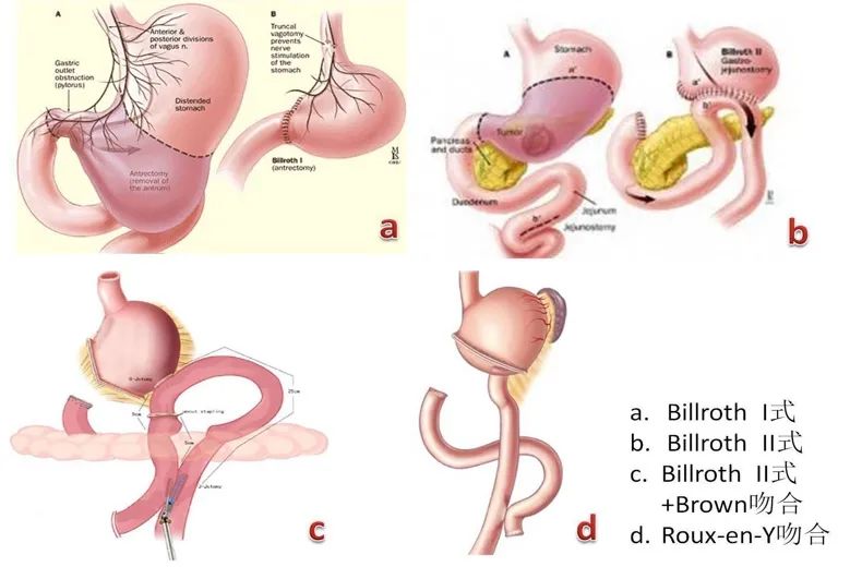 不同的胃癌手术方式