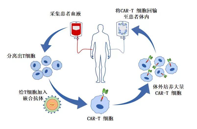 CAR-T细胞疗法治疗胃癌:新兴的希望之路